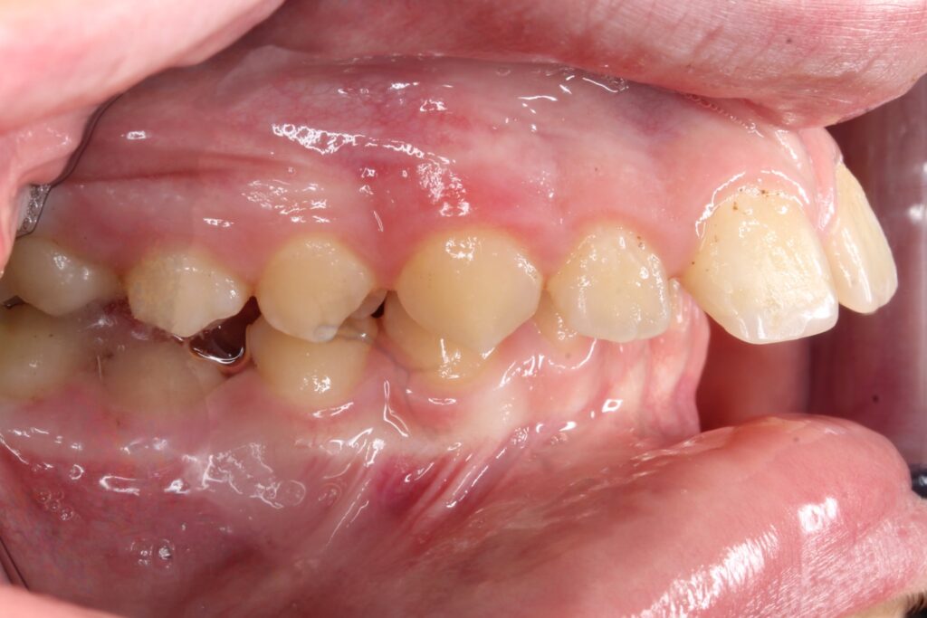 Protrusion Phillis Orthodontics in Chelmsford, MA