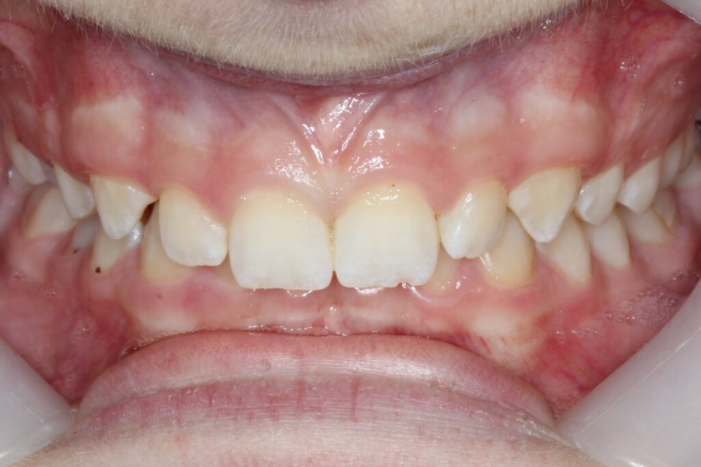 Overbite Phillis Orthodontics in Chelmsford, MA